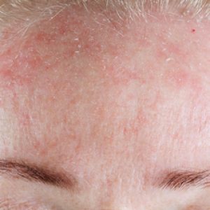 Dermatitis atópica facial