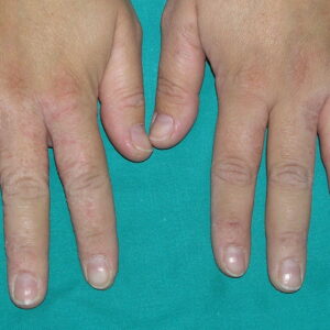 ligero Premonición El cuarto Manos secas y agrietadas: dermatitis de las manos - VS Equipo Dermatología